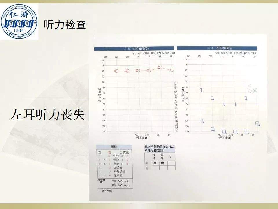 张晓华教授团队：听神经瘤切除顺序制定-仁济策略