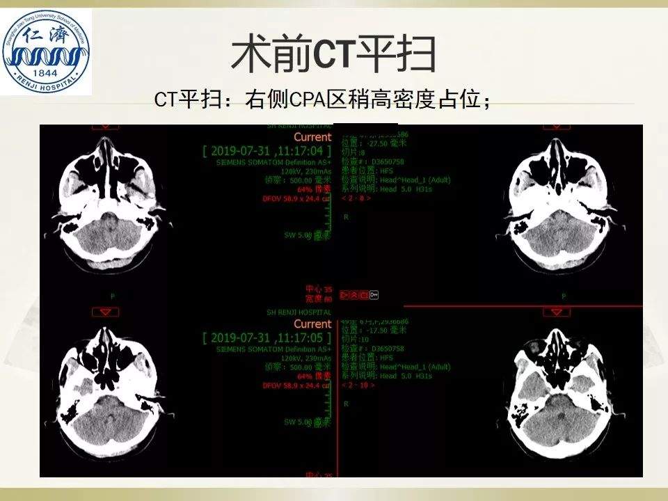 张晓华教授团队：听神经瘤切除顺序制定-仁济策略