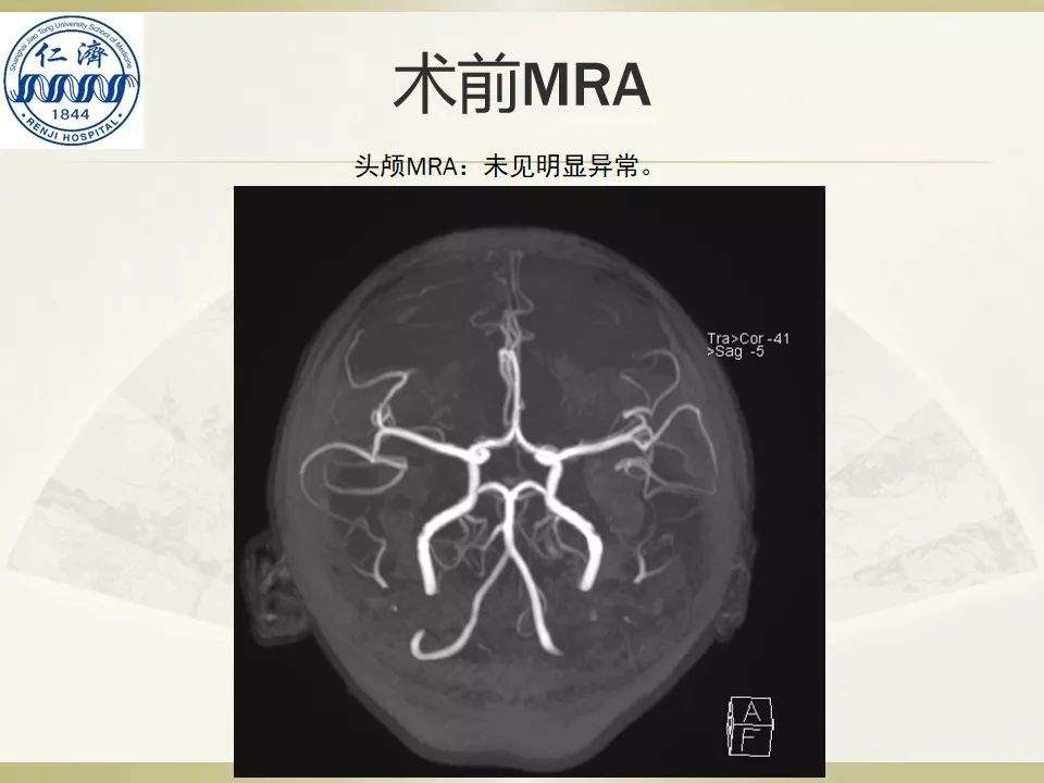 张晓华教授团队：听神经瘤切除顺序制定-仁济策略