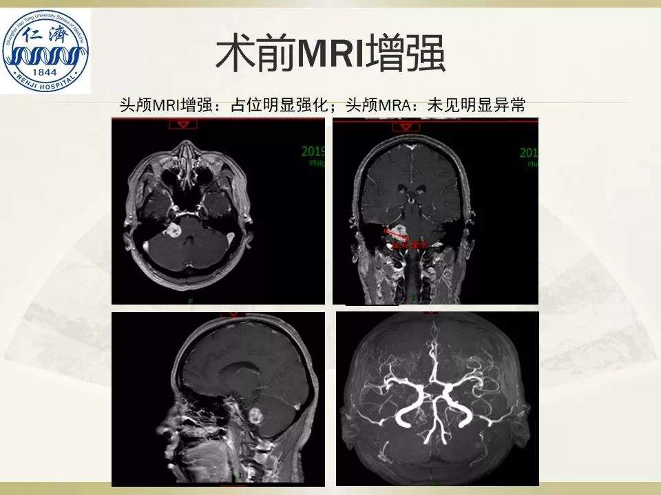 张晓华教授团队：听神经瘤切除顺序制定-仁济策略