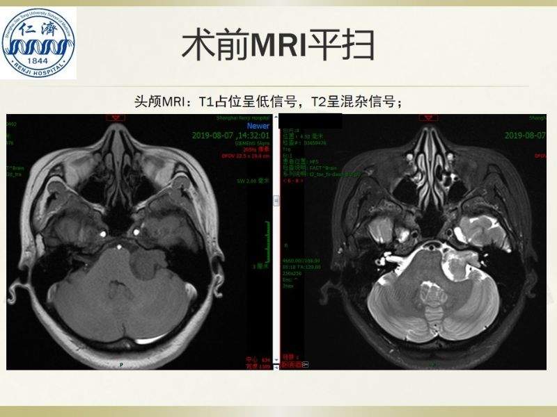 张晓华教授团队：听神经瘤切除顺序制定-仁济策略