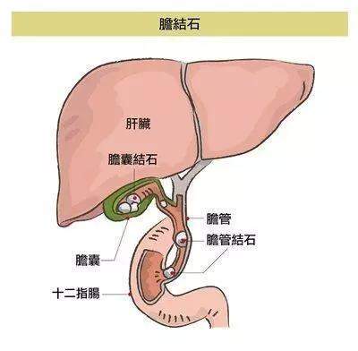 北京中山医院科普：节假日暴饮暴食警惕胆囊结石