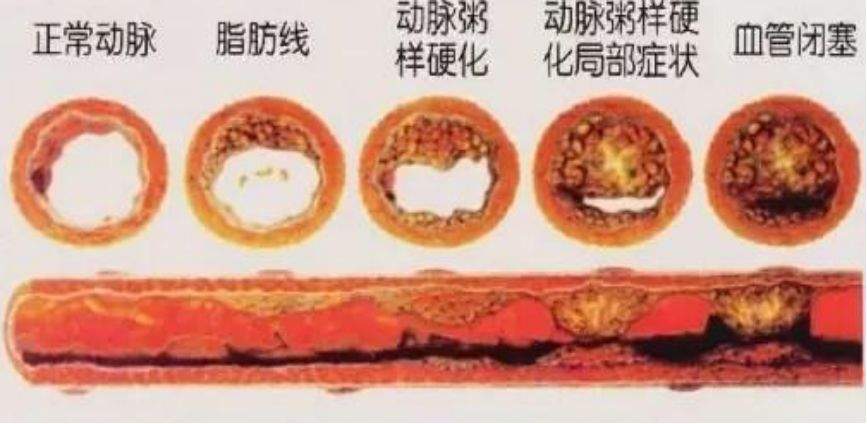 七旬老人下肢疼痛下肢血管疾病不容忽视