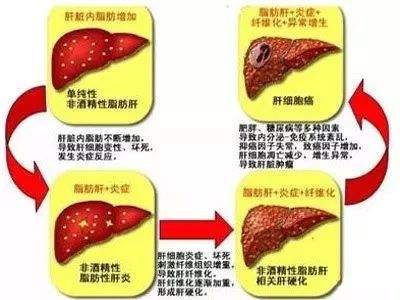 非酒精性脂肪肝之分类管理