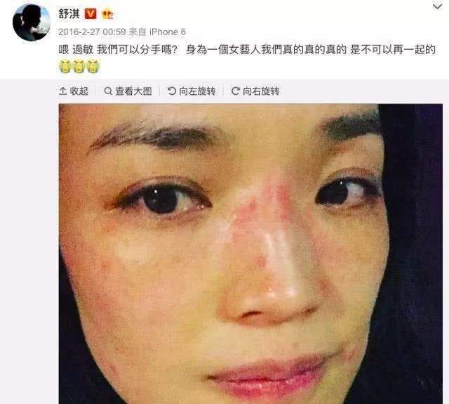 不老女神舒淇，也没能躲过烂脸……