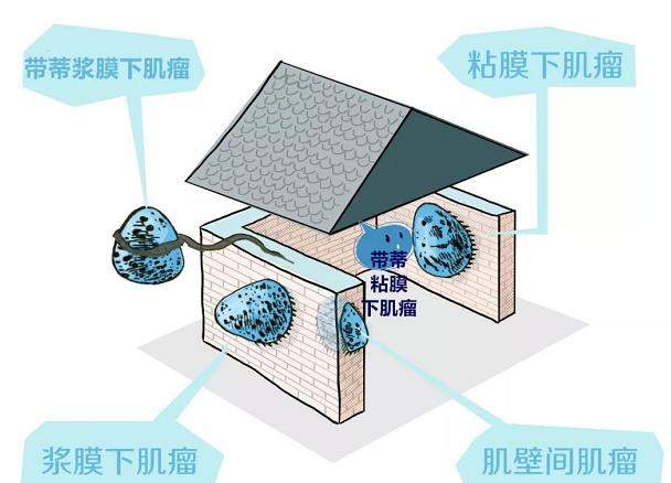 28岁白领检查出10公分子宫肌瘤，何去何从？