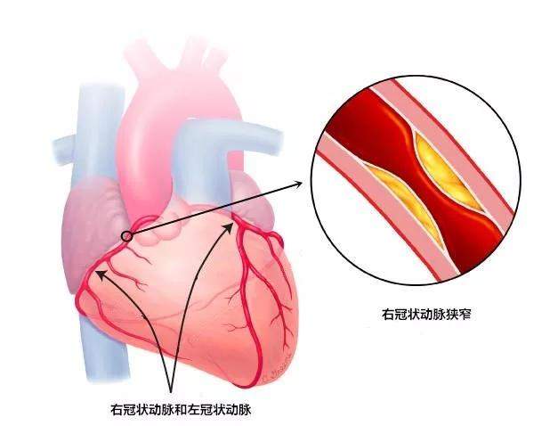闭塞的右冠状动脉通了，解除纠缠老人20年的“心病”