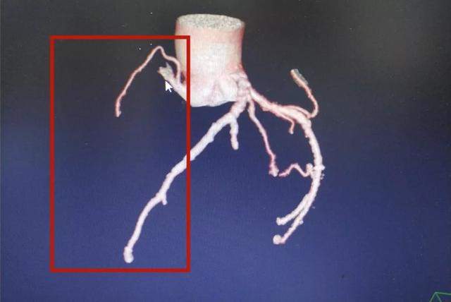 闭塞的右冠状动脉通了，解除纠缠老人20年的“心病”