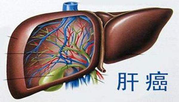 为什么这8类人肝癌高发？快看看你是不是