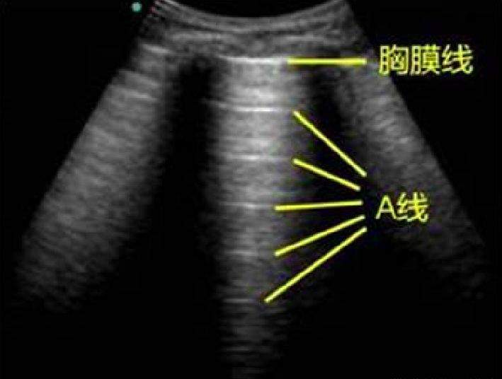 跬步千里ThroughTues！中国重症超声专家共识25-重症超声与呼吸治疗2