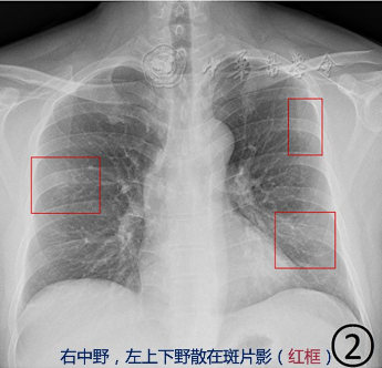 新冠病毒感染人体全过程丨援鄂医生一线经验