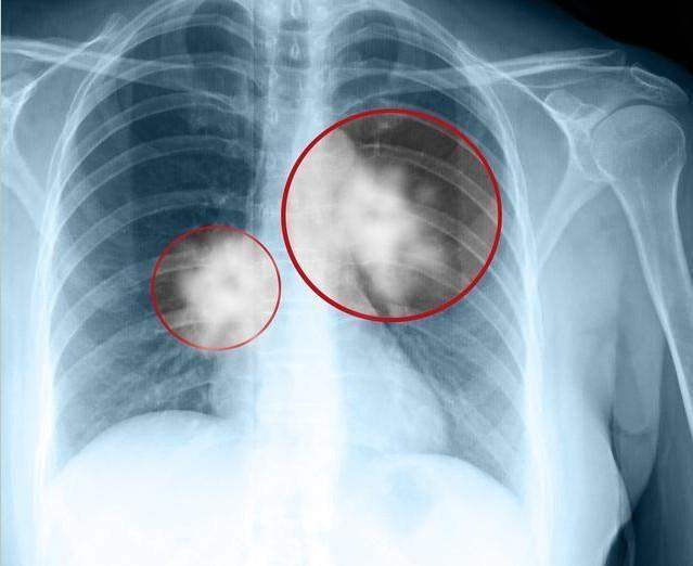 46岁男子，不痛不痒，查出肺癌，手上1个标记，提示已到中晚期