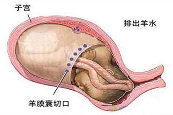 羊水栓塞是怎么引起的 孕妇怎么预防羊水栓塞