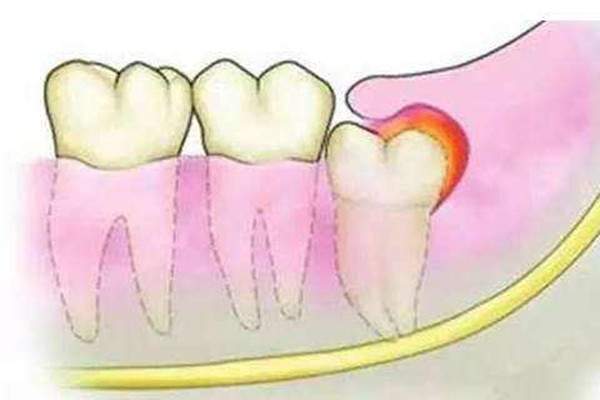 智齿一定要拔吗 怎么判断智齿要不要拔