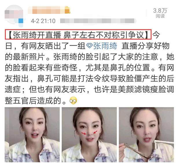 张雨绮疑似整容失败，直播鼻子不对称被吐槽，网友：颜值直线下跌