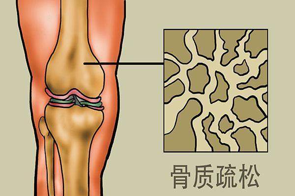 骨质疏松，都是因为缺钙吗？如何预防？