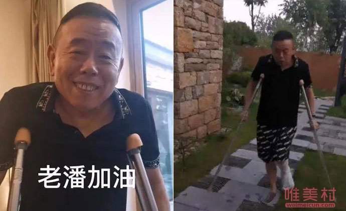 潘长江骨折跳无价之姐 潘叔左脚粉碎性骨折怎么回事