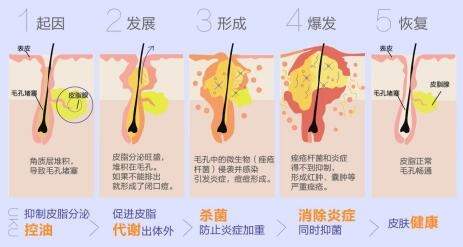 清颜祛痘方：中医治痤疮，还你一张白净脸