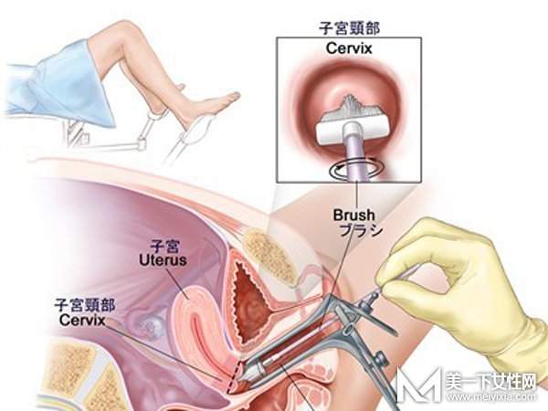 宫颈糜烂用什么药最好 怎样才能根治宫颈糜烂