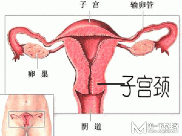 宫颈糜烂用什么药最好 怎样才能根治宫颈糜烂