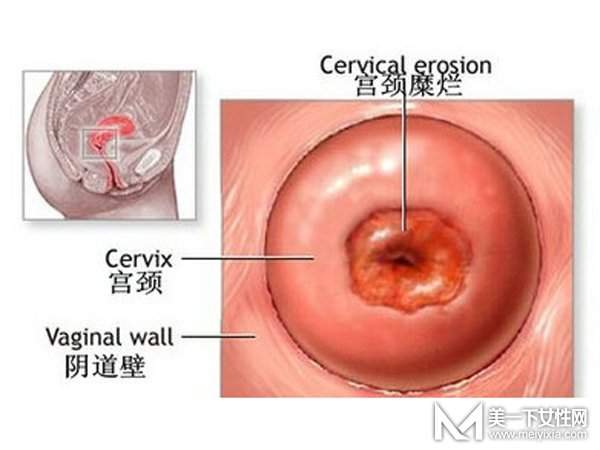 宫颈糜烂用什么药最好 怎样才能根治宫颈糜烂