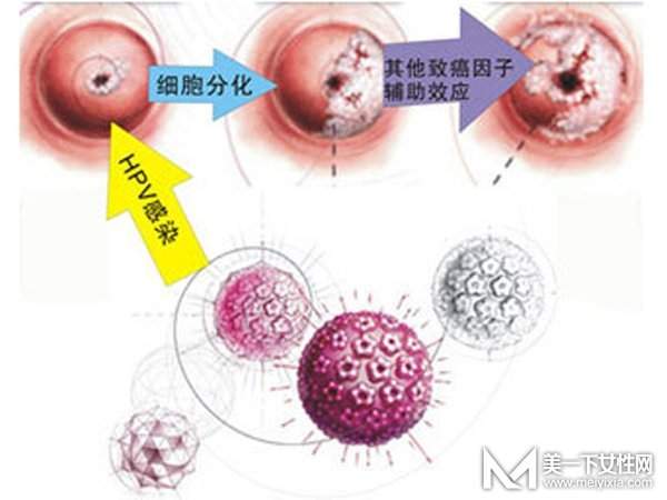 宫颈糜烂用什么药最好 怎样才能根治宫颈糜烂