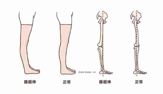 膝盖超伸怎么矫正