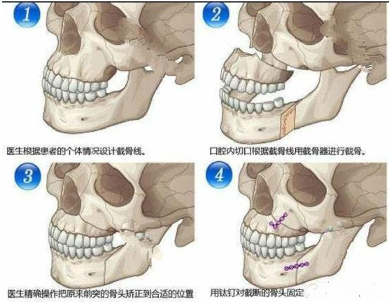 哪吒是个“地包天”？离完美颜值他还差一个正颌手术