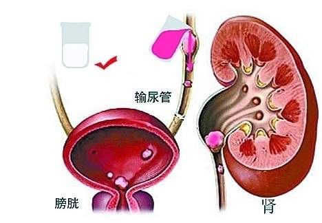 肾结石怎么治最好？分享三种治疗方法