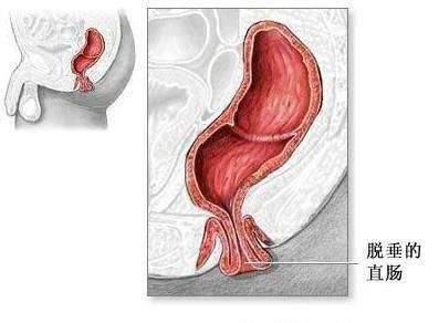 肛门外有个小肉疙瘩，你的菊花得病了！