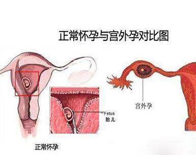 宫外孕打掉最佳时间是在什么时候？宫外孕怎么打掉孕囊