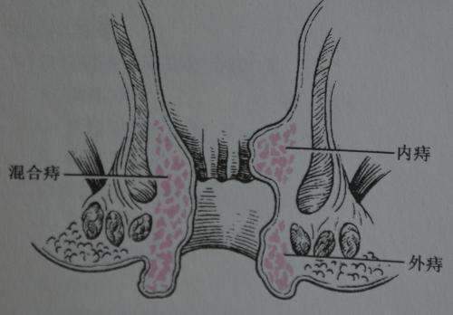痔疮外痔肉球怎么消除，根据病情来医治！