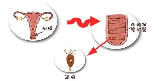 妇科炎症吃什么消炎药效果好，炎症不同用药不一样！