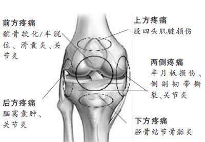 女性膝盖痛的可能问题，韧带撕裂拉伤！