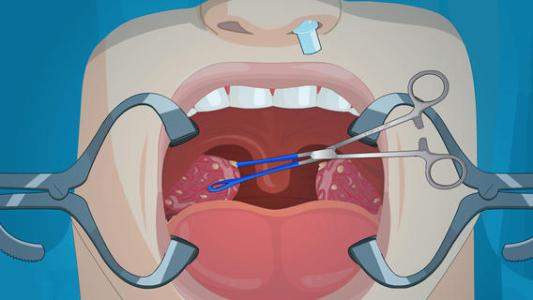 扁桃体切除后遗症有哪些？可能出现以下情况