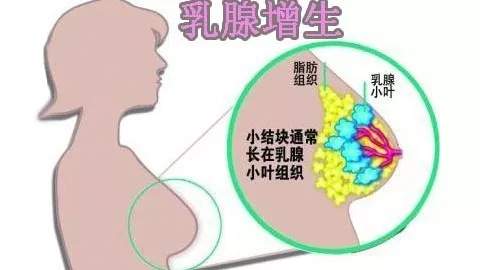 乳腺增生和乳腺结节有什么区别？乳腺增生和乳腺结节日常护理