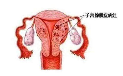 子宫腺肌症是什么病？是什么导致子宫腺肌病？